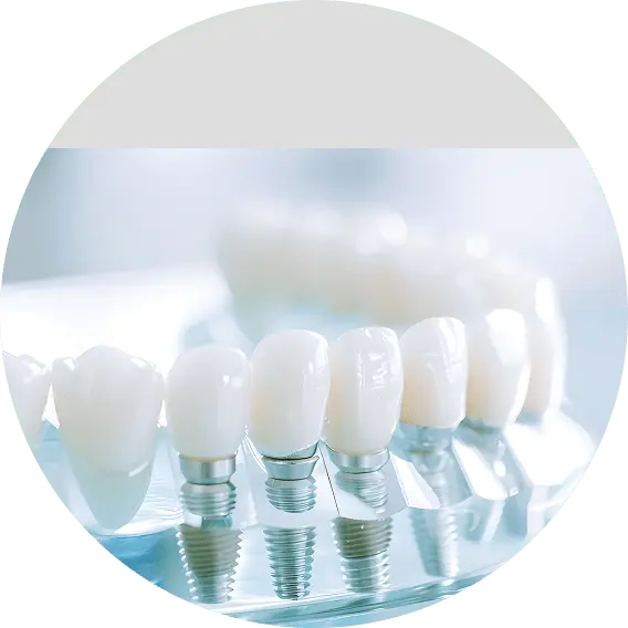 インプラントのイメージ