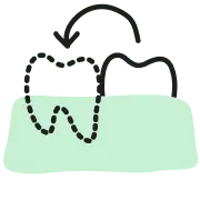 歯の移植・再植