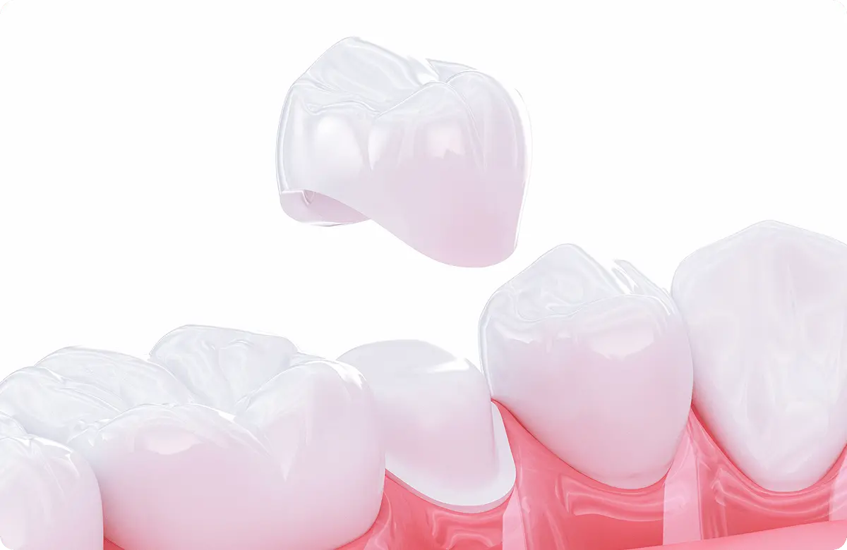 セラミック治療とは？