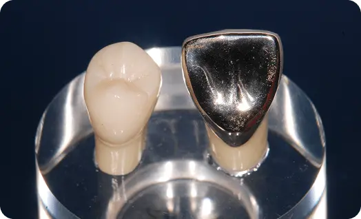 硬質レジン前装冠