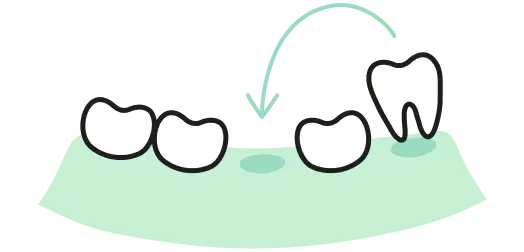 歯の移植