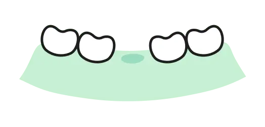 放置（抜いたまま）