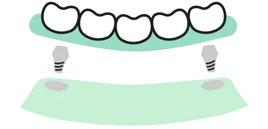 インプラントオーバーデンチャー