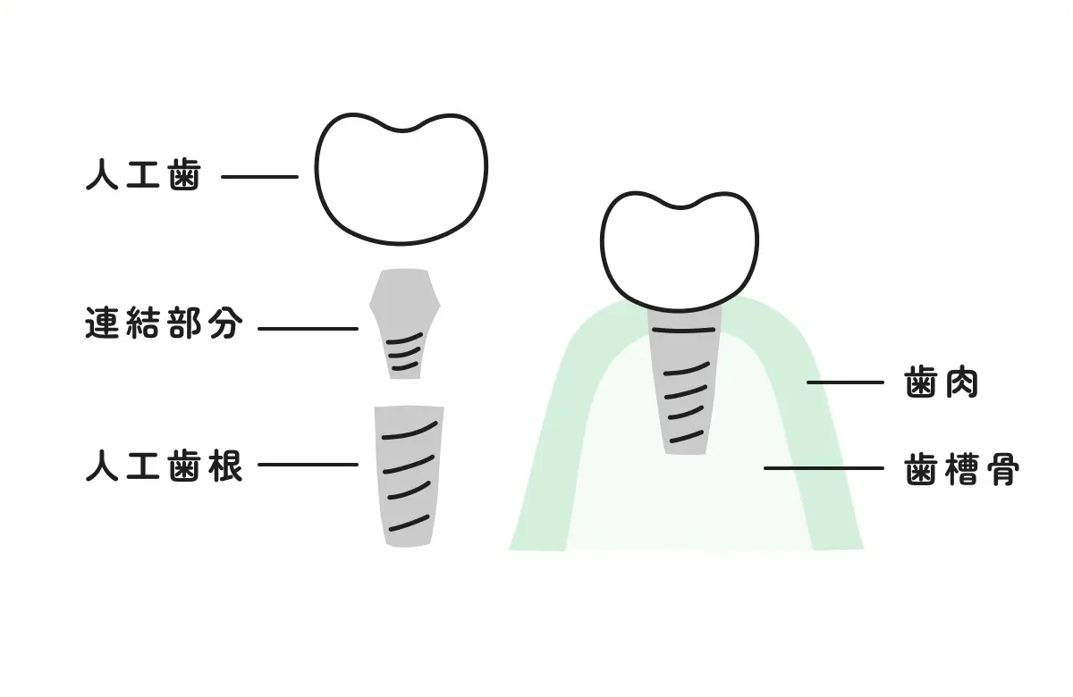 インプラントとは？