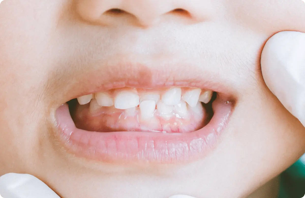 悪い歯並びの原因2