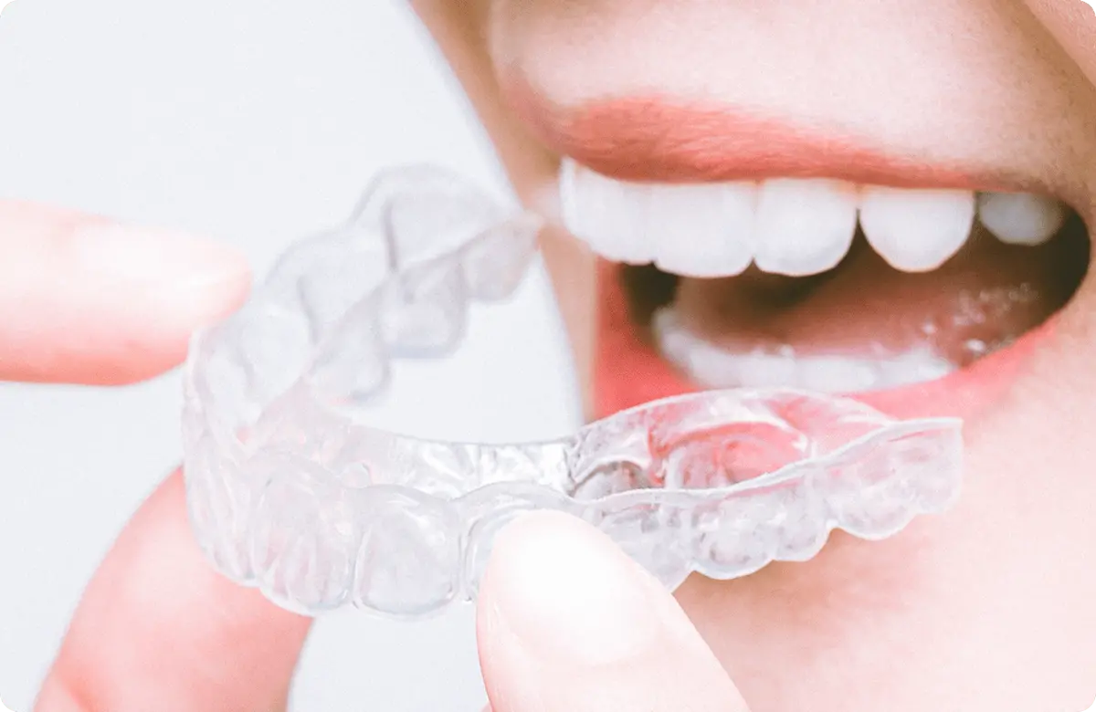 マウスピース矯正（アライナー矯正）
