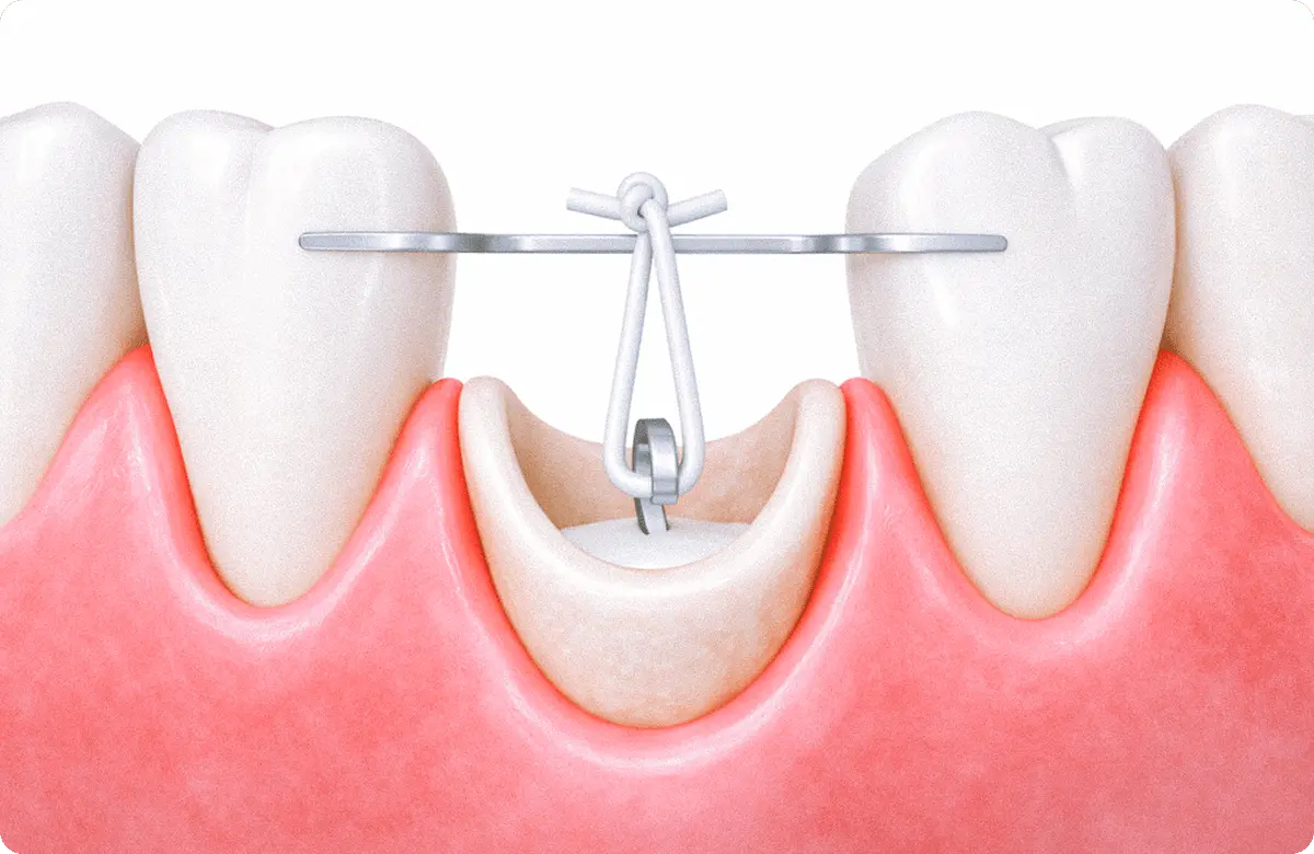 挺出（ていしゅつ）