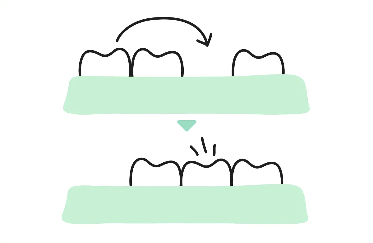 歯の移植とは？