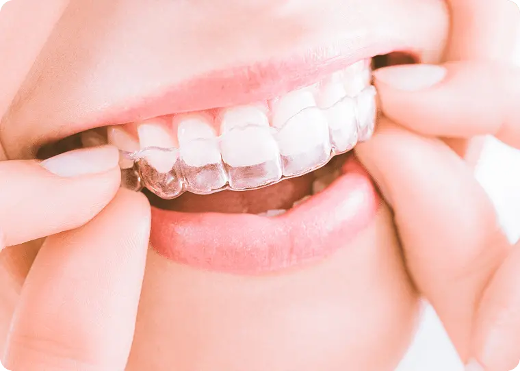 ホームホワイトニング