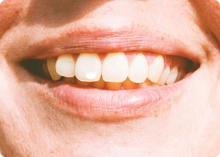 ホワイトスポット治療