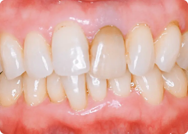 ウォーキングブリーチ