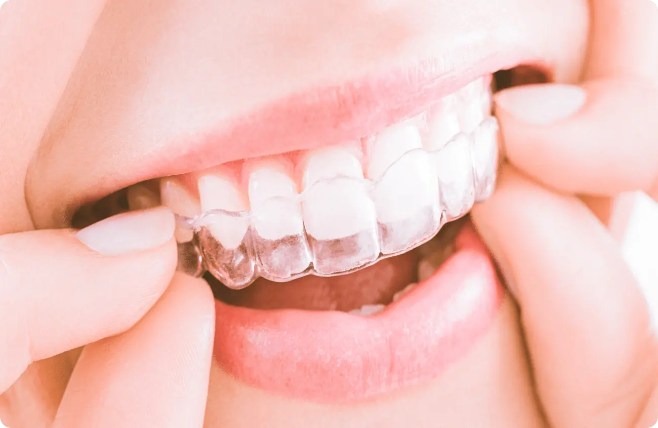 ホームホワイトニング