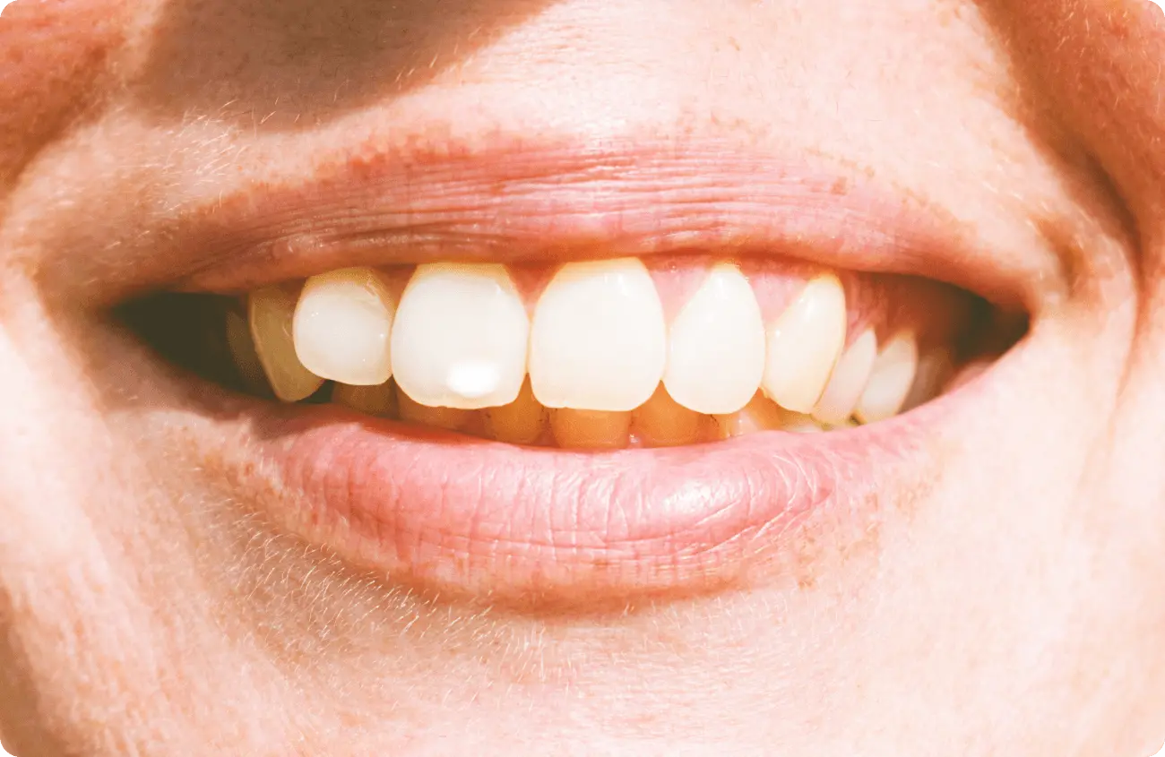 ホワイトスポット治療