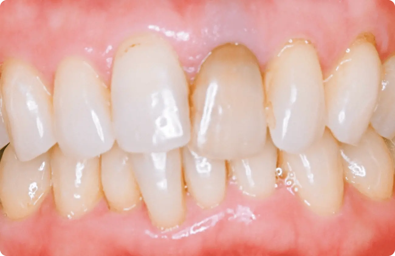 ウォーキングブリーチ